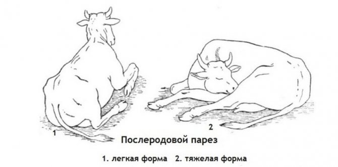 Послеродовой парез